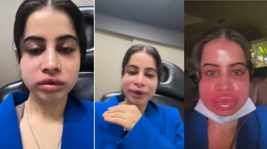 Urfi Javed: उर्फी जावेद के होठो को क्या हुआ और क्यों सूज गये : होठों की फिलिंग हटवाने का वीडियो वायरल