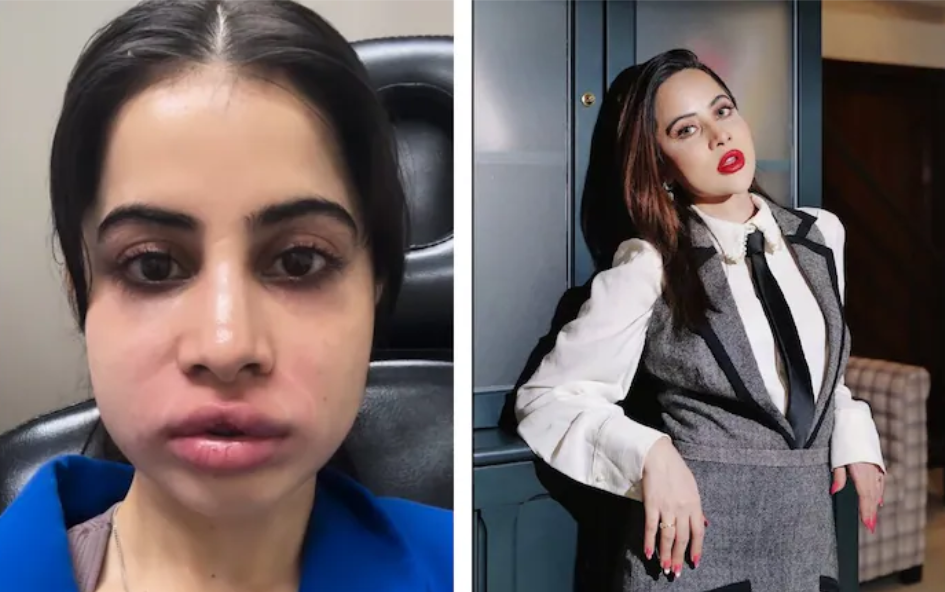 Urfi javed lips news: उर्फी जावेद होठो को ऐसे केसे हुआ: 9 साल बाद हटवाए लिप फिलर्स, वीडियो देख फैंस हैरान